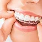 Best Dental Implants in Surat